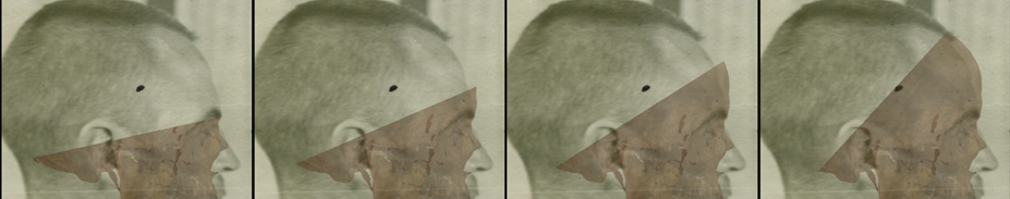 Ejemplo de un solapamiento negativo en vista lateral en la que se evalúa el contorno de la frente con Skeleton·ID mediante las herramientas de transparencia y barrido, mostrando que el contorno del hueso frontal no sigue el contorno de la frente de manera consistente. La herramienta de barrido se ha utilizado para mostrar un gradiente desde el margen supraorbital al hueso frontal. En este caso, se puede observar como el contorno del frontal en el cráneo sobresale del contorno de la frente en la cara en la fotografía