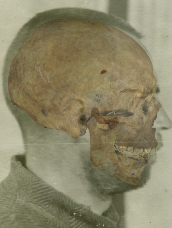 Example of a positive match in which the skull height is evaluated with the transparency tool, showing that the skull and head height is similar in a consistent way.  In this case the distortion in the perception created by presence of hair is minimal facilitating the evaluation of this criterion