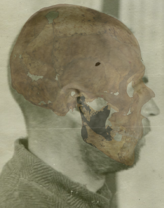 Ejemplo de un solapamiento negativo en vista lateral en la que se evalúa la altura del cráneo con Skeleton·ID mediante la herramienta de transparencia, mostrando que la altura del cráneo y de la cabeza es incompatible y los contornos no son consistentes entre sí. En este caso, se puede observar como el contorno de la bóveda craneal, el hueso frontal y el nasal sobresalen del contorno facial