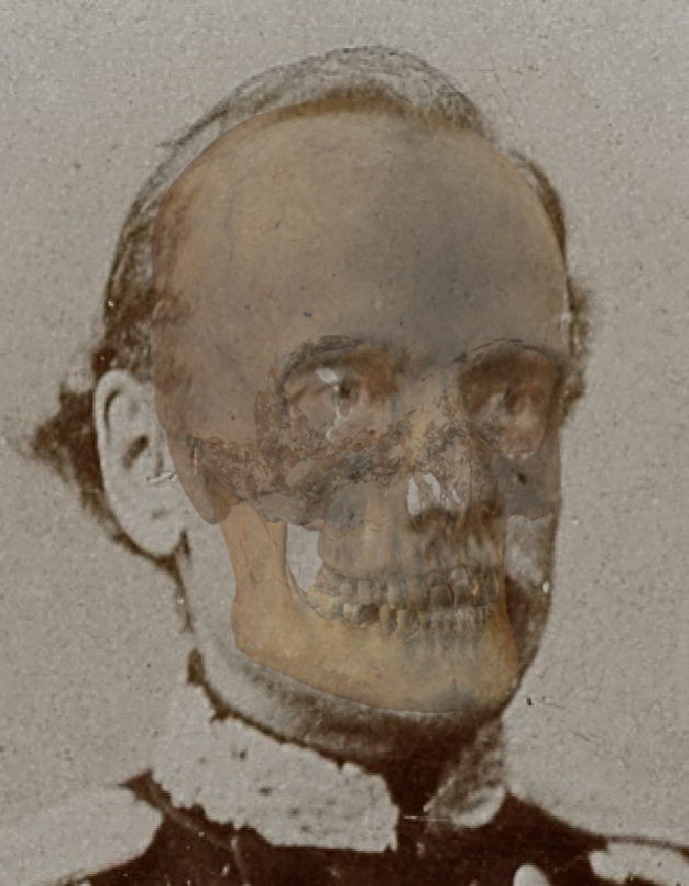 Example of a positive match in which the skull height is evaluated with the transparency tool, showing that the skull and head height is similar in a consistent way.  In this case the distortion in the perception created by presence of hair is minimal facilitating the evaluation of this criterion