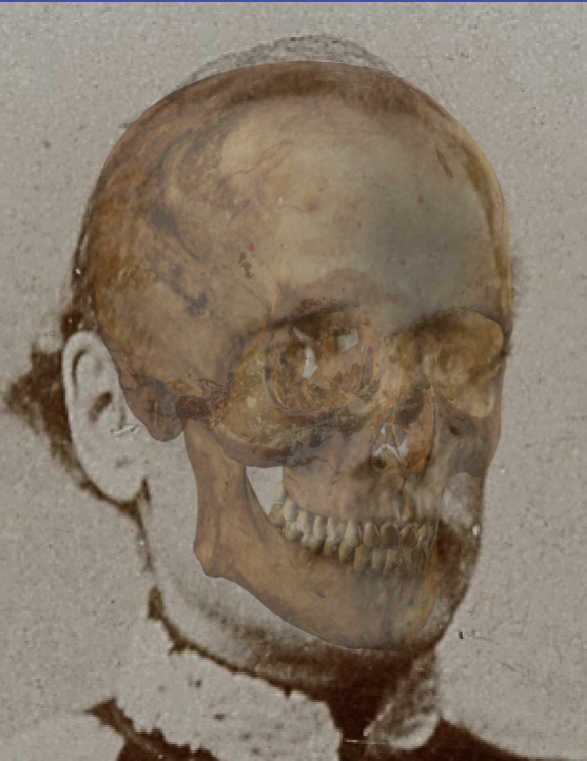 Example of a negative match in which the skull height is evaluated with the transparency tool, showing that the skull and head height is not similar in a consistent way.  In this case the distortion in the perception created by presence of hair is minimal facilitating the evaluation of this criterion and it can be seen how the upper cranial contour protrudes from the upper facial contour so that the height of the skull is greater than the height of the face