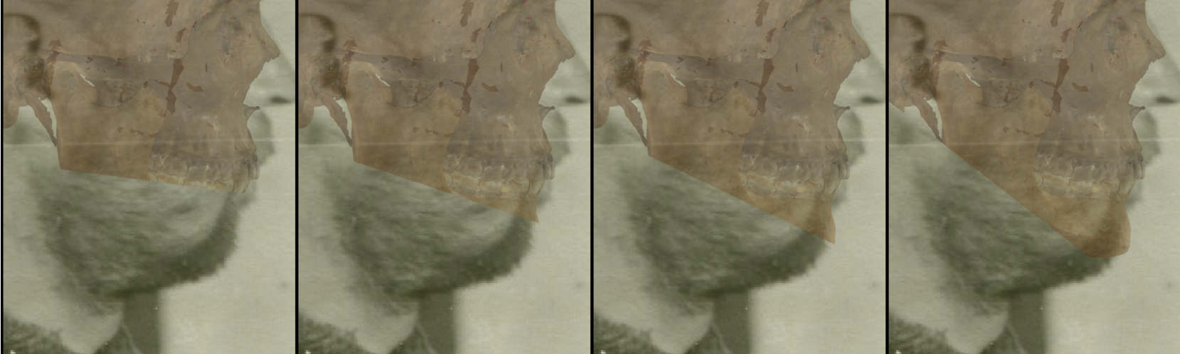 Ejemplo de un solapamiento negativo en vista lateral en la que se evalúa el contorno del mentón con Skeleton·ID mediante las herramientas de transparencia y barrido, mostrando que el contorno de la barbilla en la foto no sigue el contorno del mentón en el cráneo de manera consistente. La herramienta de barrido se ha utilizado para mostrar un gradiente de derecha a izquierda del contorno del mentón