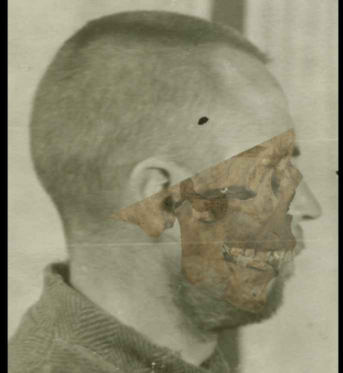 Example of a positive match in which the forehead outline is evaluated with Skeleton·ID by means of the transparency and wipe tools, showing that the outline of the frontal bone follows the forehead outline in a consistent way. The wipe tool has been used to show a gradient from the supraorbital margin to the forehead