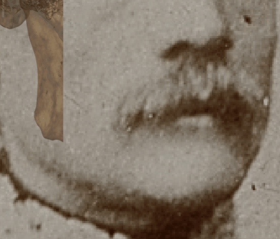 Example of a negative match in which the chin outline is evaluated with the transparency and wipe tools, showing that the chin outline is not consistent with the mental outline. The wipe tool has been used to show a gradient from right to left (anatomical) of the mental outline (skull) over the chin outline. In this case the mental outline does not follow until the end of the chin, turning out to be narrower showing an incompatible inconsistency