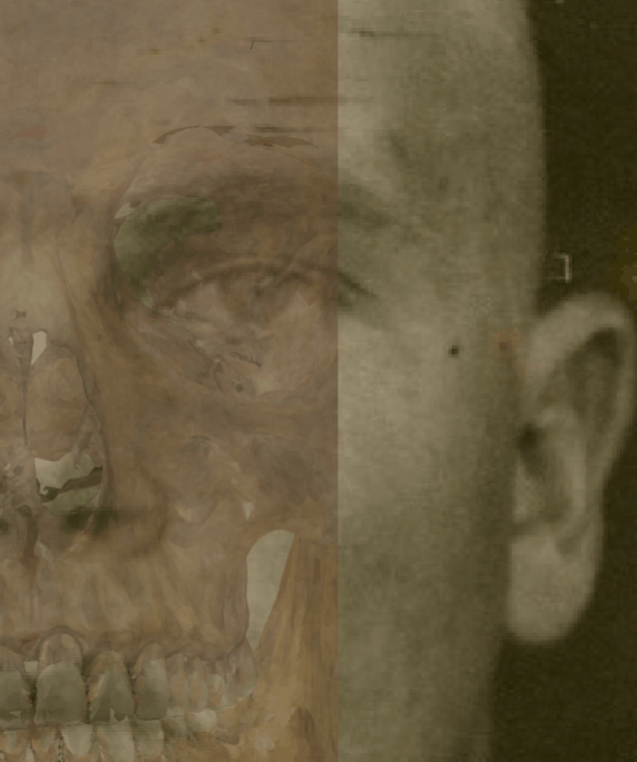 Example of a negative match in which the lateral line of the zygomatic bone is evaluated with Skeleton·ID by means of the transparency and wipe tools, showing that the lateral line of the zygomatic bone does not match the lateral line of the cheek on the face. The zygomatic bone does not reach the contour of the cheek on the face