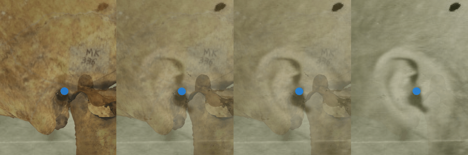 Example of a positive match in which the position of the right porion is visually evaluated with Skeleton·ID by means of the transparency tool, showing that the right porion aligns posterior to the tragus, slightly inferior to the crus of the helix in a consistent way. The transparency tool has been used to show a gradient of opacity of the auditive meatus showing the position of the porion over the ear