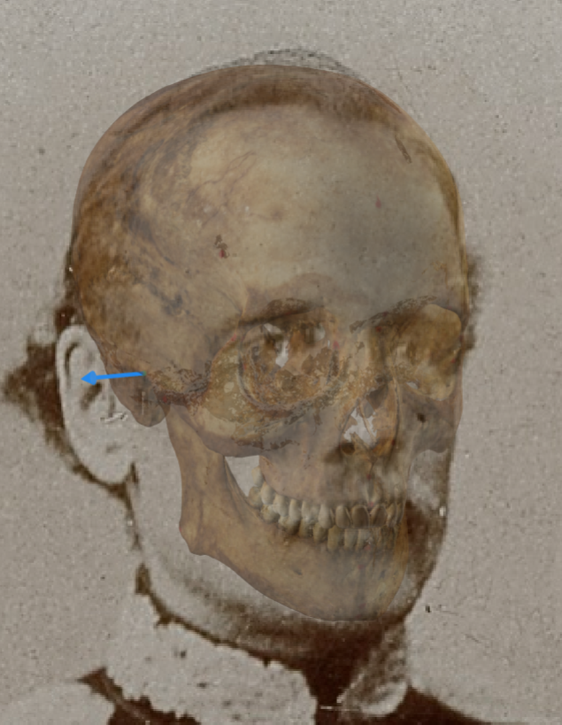 Example of a negative match in which the position of the right porion is visually evaluated with Skeleton·ID by means of the transparency tool, showing that the right porion does not align posterior to the tragus, and it is located over the crus of the helix in an inconsistent way. The transparency tool has been used to show a gradient of opacity of the auditive meatus showing the position of the porion over the ear