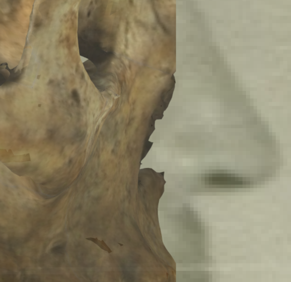 Example of a positive match in which the position of the anterior nasal spine is visually evaluated with Skeleton·ID by means of the transparency tool, showing that the anterior nasal spine lies posterior to the base of the nose, near the most posterior portion of the septal cartilage, in a consistent way