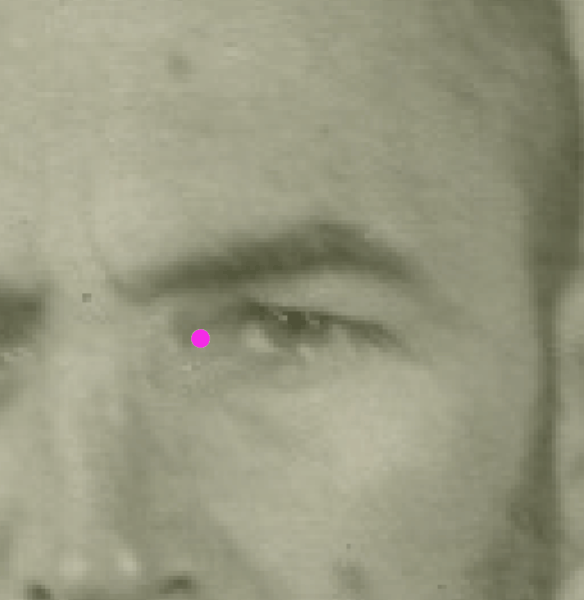 Example of a negative match in which the endocanthion is visually evaluated with Skeleton·ID by means of the transparency tool, showing that the right endocanthion in the face is not aligned with the medial margin of the orbit. The transparency tool has been used to show a gradient of opacity of the orbit
