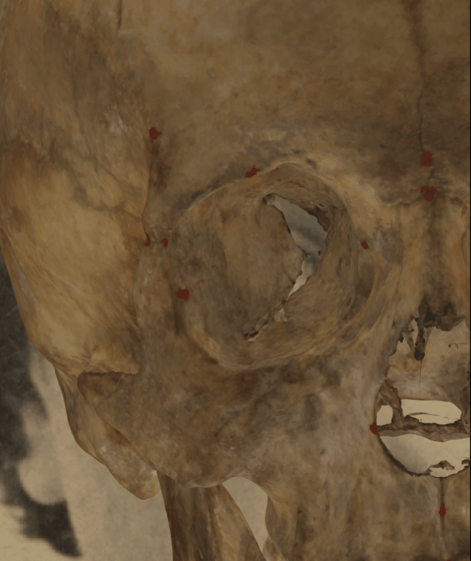 Example of a positive match in which the exocanthion is visually evaluated with Skeleton·ID by means of the transparency tool, showing that the right exocanthion in the face is aligned with the Whitnall´s tubercle on the horizontal plane. The orbital width is consistent with the eye-slit width. The transparency tool has been used to show a gradient of opacity of the orbit