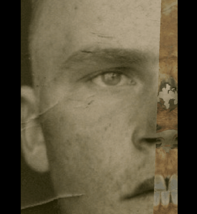 Example of a positive match in which the right eyebrow is visually evaluated with Skeleton·ID by means of the transparency and wipe tools, showing that the right eyebrow follows the upper edge of the orbit and at the lateral superior one-third of the orbit it continues horizontally while the orbital ring descends in in a consistent way. The transparency tool has been used in combination with the wipe tool to show a gradient from the medial side of the orbital rim to the lateral side monitoring the eyebrow position