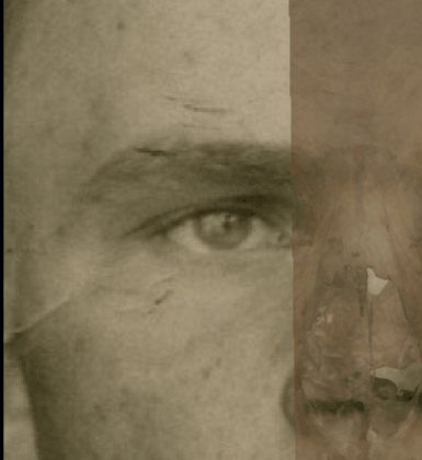 Example of a negative match in which the right eyebrow is visually evaluated with Skeleton·ID by means of the transparency and wipe tools, showing that the right eyebrow follows the upper edge of the orbit and at the lateral superior one-third of the orbit it does not continues horizontally as it is covered by the orbital ring in an inconsistent way. The transparency tool has been used in combination with the wipe tool to show a gradient from the medial side of the orbital rim to the lateral side monitoring the eyebrow position
