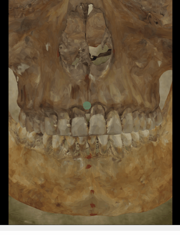 Example of a positive match in which the occlusal line is evaluated with the transparency and wipe tools, showing that the occlusal and the lip closure line are consistent. The transparency tool has been used in combination with the wipe tool to show a gradient from the right corner (anatomical) of the mouth to the left corner monitoring the occlusal line over the lip closure line