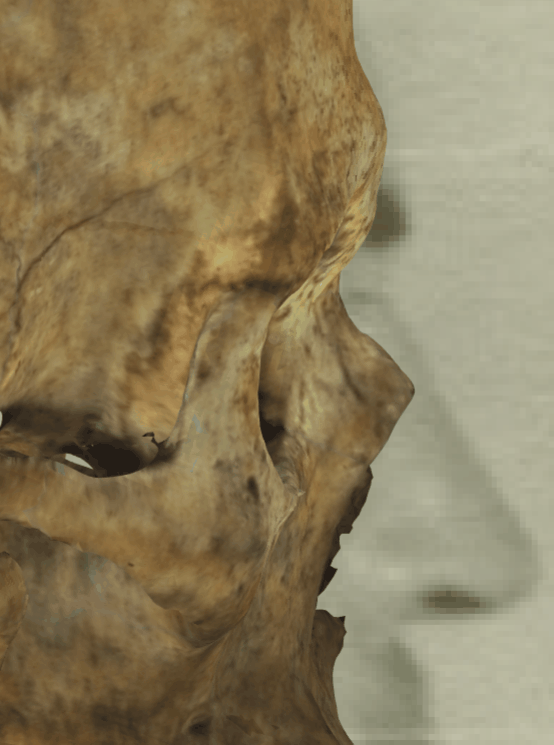 Example of a positive match in which the position of the right exocanthion is visually evaluated with Skeleton·ID by means of the transparency tool, showing that the position of the rigth exocanthion approximates the right lateral margin of the orbit in a consistent way. The transparency tool has been used to show a gradient of opacity of the orbital rim