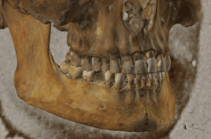 Example of a positive match in which the stomion is visually evaluated with Skeleton·ID by means of the transparency tool, showing that the stomion in the face lies at the central incisors (incision landmark) in a consistent way. The transparency tool has been used to show a gradient of opacity over the teeth showing the position of stomion in relation to the central incisors