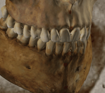 Ejemplo de un solapamiento negativo en vista oblicua en la que se evalúa la posición del stomion con Skeleton·ID mediante la herramienta de transparencia, mostrando que el stomion no se sitúa sobre los incisivos centrales en la línea oclusal de manera consistente. La herramienta de transparencia se ha utilizado para mostrar un gradiente de opacidad sobre los dientes mostrando la posición de stomion en relación a los incisivos centrales superiores. En este caso, se puede observar como el stomion se localiza sobre el incisivo superior izquierdo