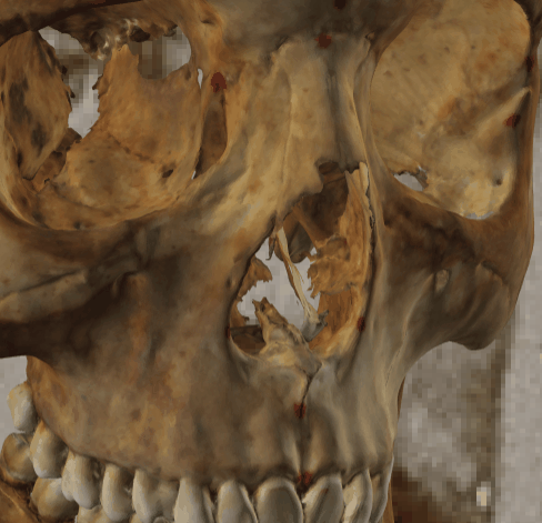 Example of a negative match in which the subnasale position is visually evaluated with Skeleton·ID by means of the transparency tool, showing that the subnasale does not matche the lower margin of the piriform aperture. The transparency tool has been used to show a gradient of opacity of the piriform aperture