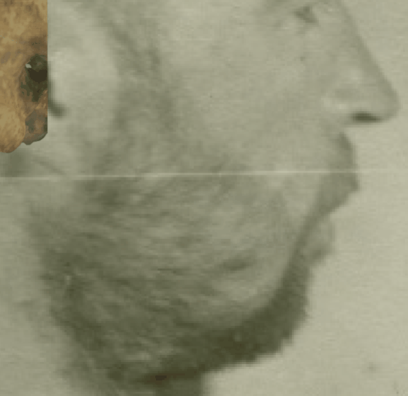 Example of a positive match in which the position of the gonial flare is visually evaluated with Skeleton·ID by means of the wipe tool, showing that the gonial flare in the skull and the postero-lateral jaw prominence in the face are consistent. The wipe tool has been used to show a gradient of the right jaw