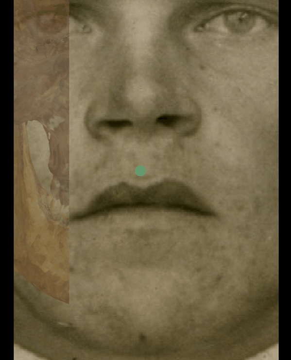 Example of a negative match in which the occlusal line is evaluated with the transparency and wipe tools, showing that the occlusal and the lip closure line are inconsistent. The transparency tool has been used in combination with the wipe tool to show a gradient from the right corner (anatomical) of the mouth to the left corner monitoring the occlusal line over the lip closure line