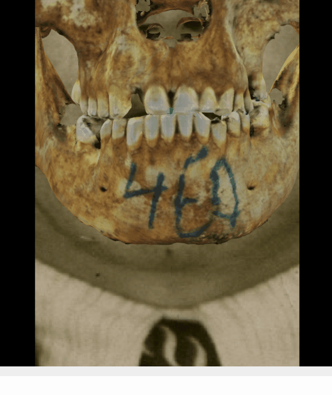 Ejemplo de un solapamiento positivo en vista frontal en la que se evalúa el stomion con Skeleton·ID mediante la herramienta de transparencia, mostrando que el stomion se encuentra sobre los incisivos centrales superiores (el punto verde representa el punto incision en el cráneo, homólogo del stomion) de manera consistente. La herramienta de transparencia se ha utilizado para mostrar un gradiente de opacidad sobre los dientes mostrando la posición del stomion en relación a los incisivos centrales superiores
