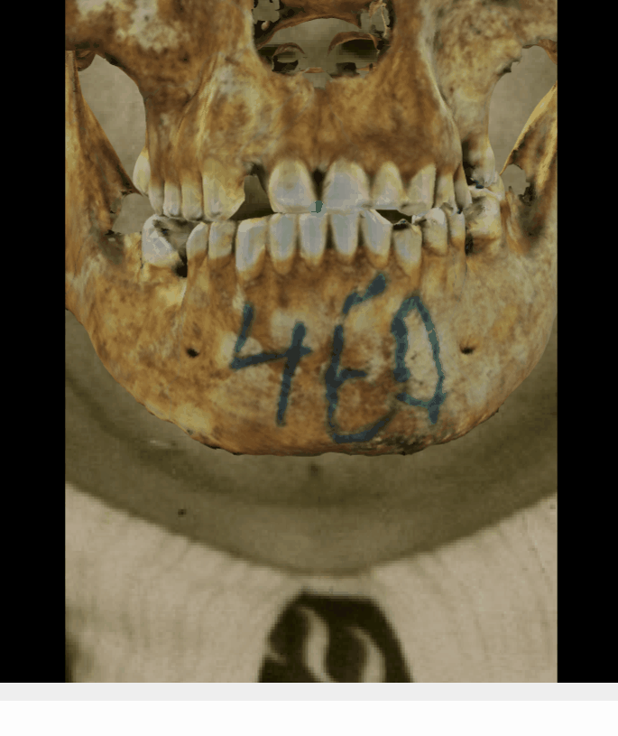 Example of a positive match in which the stomion is visually evaluated with Skeleton·ID by means of the transparency tool, showing that the stomion in the face lies at the central incisors (incision landmark) in a consistent way. The transparency tool has been used to show a gradient of opacity over the teeth showing the position of stomion in relation to the central incisors