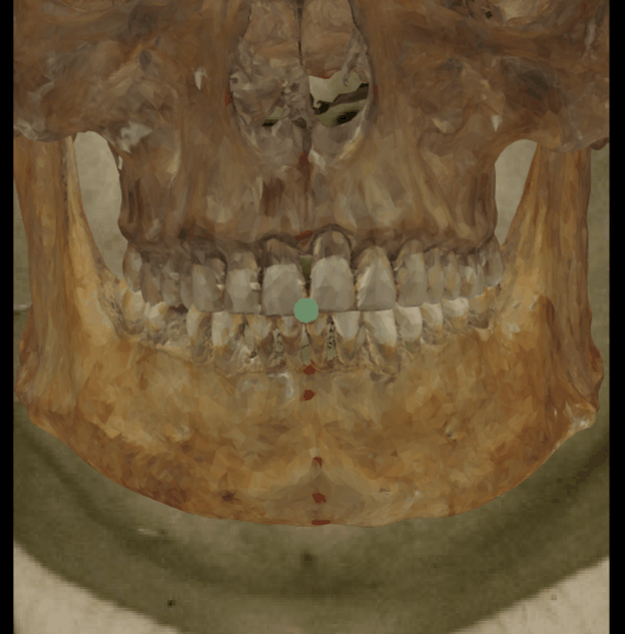 Ejemplo de un solapamiento negativo en vista frontal en la que se evalúa el stomion con Skeleton·ID mediante la herramienta de transparencia, mostrando que el incision no se encuentra sobre la posición del stomion en la boca de manera consistente. La herramienta de transparencia se ha utilizado para mostrar un gradiente de opacidad sobre los dientes mostrando la posición del incision en relación a la posición de stomion