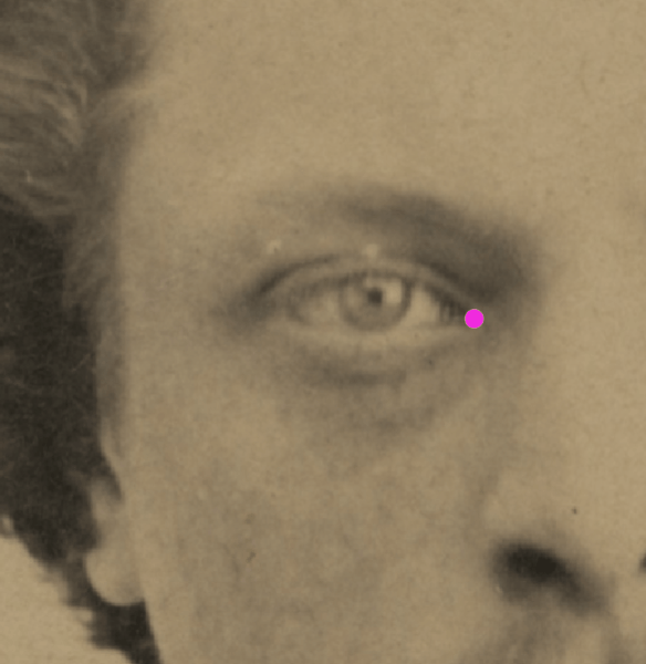 Example of a positive match in which the endocanthion is visually evaluated with Skeleton·ID by means of the transparency tool, showing that the right endocanthion in the face is aligned and superimposed over the medial margin of the orbit. The transparency tool has been used to show a gradient of opacity of the orbit